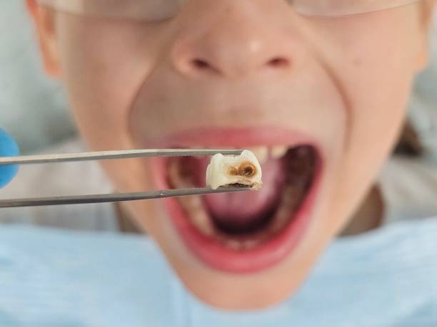 Best Emergency Dental Care for Abscessed Tooth in Woodburn, IN