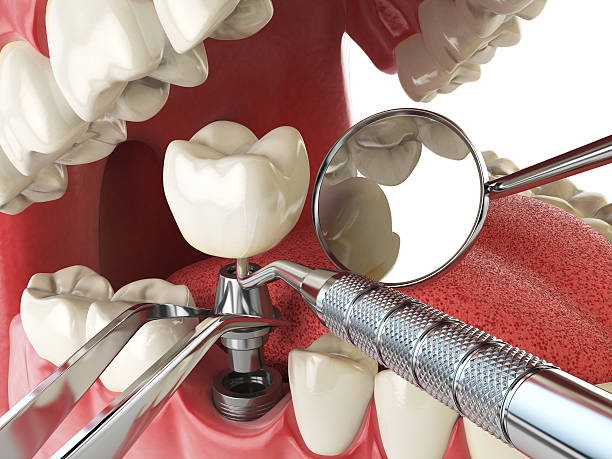 Best Emergency Dentist for Knocked-Out Tooth in Woodburn, IN